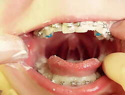 Abrading roughly braces - sandbar video - food good-luck piece - mouth fatigued